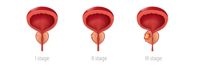 Prostate Cancer Doctor in Juhu,Andheri